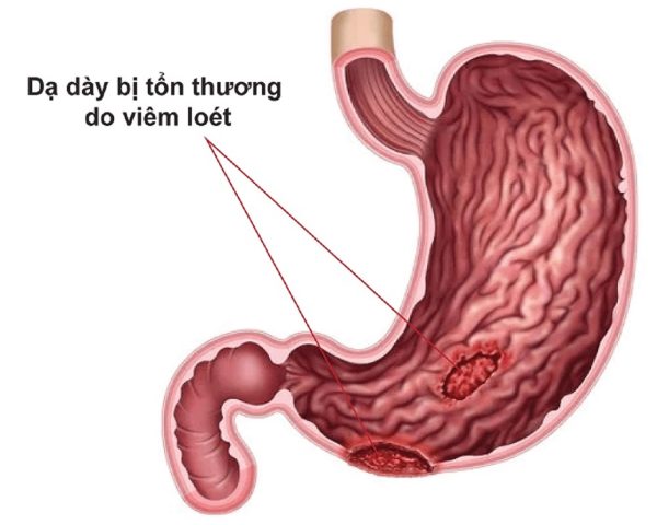 Bị loét bao tử có gây nhiều nguy hiểm không? Nên ăn gì, kiêng gì?