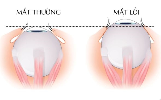 Bị lồi mắt là như thế nào? Phương pháp điều trị lồi mắt ra sao?