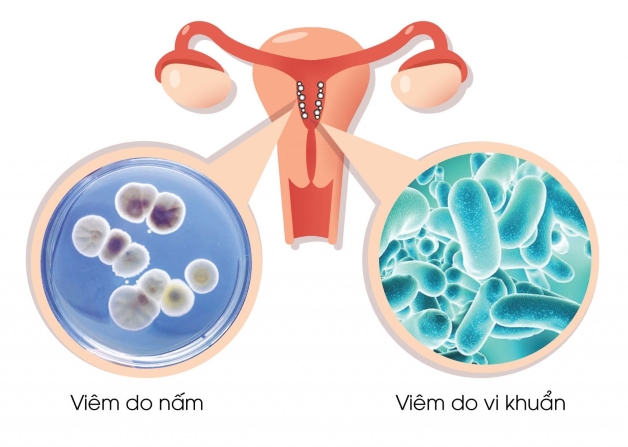 Bị nhiễm nấm vùng kín – Nguyên nhân và cách điều trị?