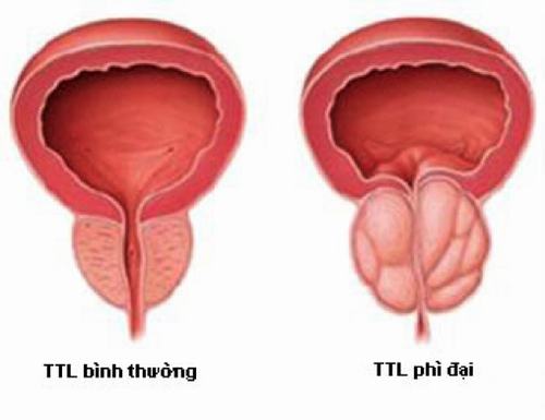 Bị phì đại tuyến tiền liệt chữa thế nào?