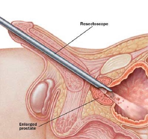 Bị phì đại tuyến tiền liệt chữa thế nào?