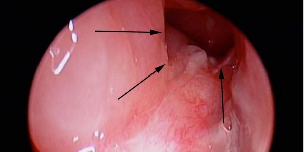 Bị Polyp cổ tử cung có quan hệ được không?