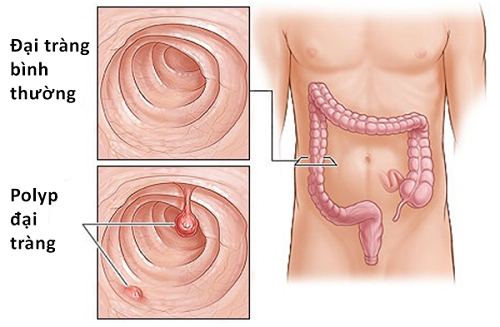 Bị polyp đại tràng nên kiêng gì?