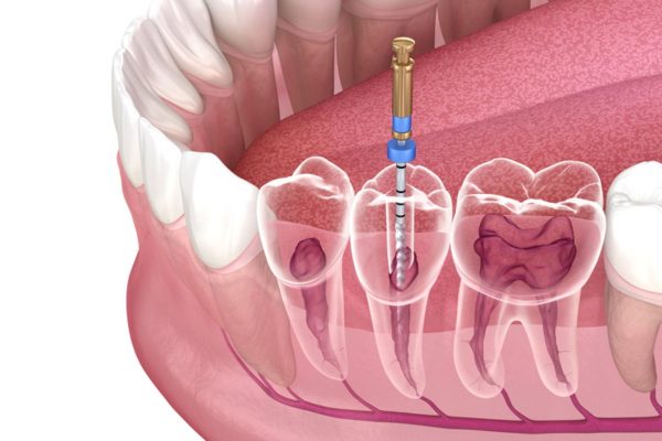 Bí quyết chăm sóc răng đã lấy tủy đúng cách