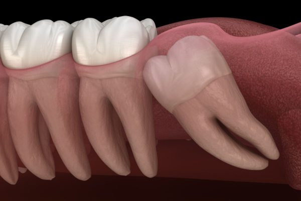 Bí quyết chăm sóc răng khôn sau khi nhổ