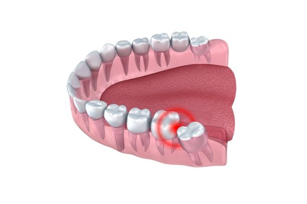 Bí quyết chăm sóc răng số 8 sau khi nhổ đúng cách