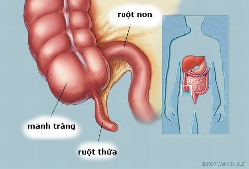 Bí quyết điều trị viêm ruột thừa thành công