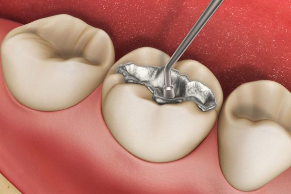 Bí quyết nha khoa: Chăm sóc răng sau khi hàn trám