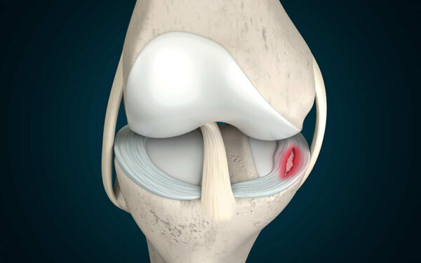 Bị rách sụn chêm đầu gối có tự lành lại không?