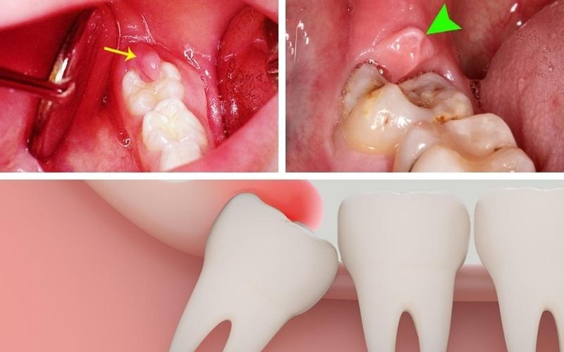 Bị sưng lợi hàm dưới trong cùng – Nguyên nhân và cách điều trị