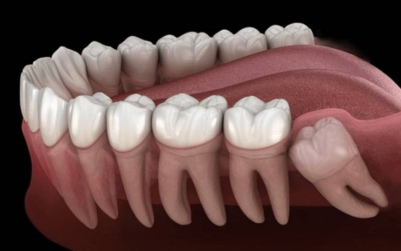 Bị sưng nướu răng trong cùng hàm dưới và giải pháp điều trị