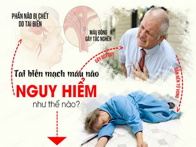 Bị tai biến mạch máu não có nguy hiểm? Dấu hiệu nhận diện