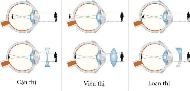 Bị tật khúc xạ có thể chữa bằng những phương pháp nào?