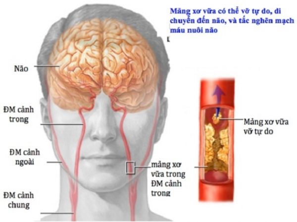 Bị thiếu máu não và cách chữa trị theo chuyên gia