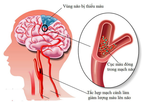 Bị thiếu máu não: xử trí sai cách tai hại khó lường