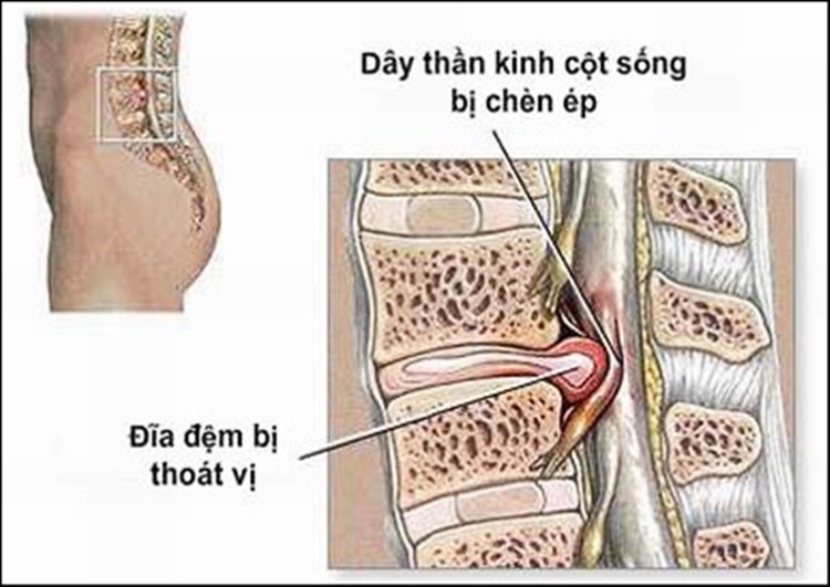 Bị thoát vị đĩa đệm cần kiêng gì?