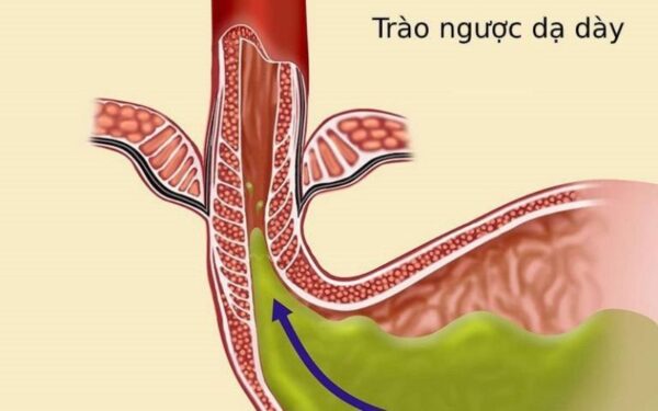 Bị trào ngược dạ dày thực quản do đâu? Điều trị như thế nào?