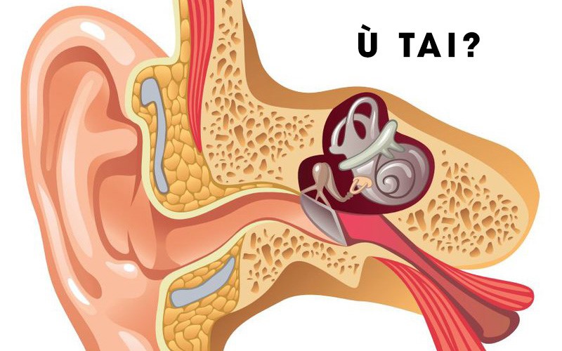 Bị ù tai – Cẩn trọng nguyên nhân do nhiều bệnh lý