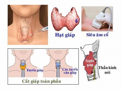 Bị u tuyến giáp lành tính có nên phẫu thuật không?