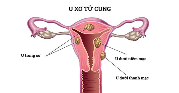 Bị u xơ khi mang thai có gây nguy hiểm không?