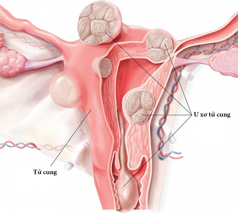 Bị u xơ tử cung đặt vòng tránh thai và những điều cần lưu ý