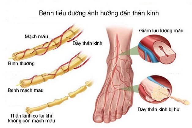 Bị viêm dây thần kinh có nguy hiểm không?