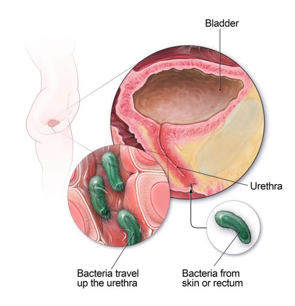 Bị viêm đường tiết niệu là do đâu