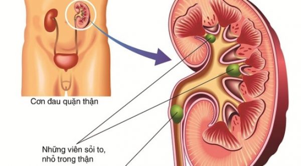 Bị viêm đường tiết niệu là do đâu