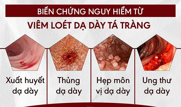 Bị viêm loét tá tràng cần lưu ý gì về ăn uống và sinh hoạt?