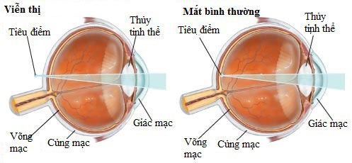 Bị viễn thị có chữa được không?