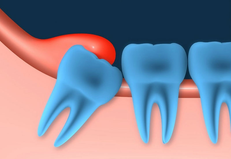 Bị vôi răng – Nguyên nhân, tác hại và cách phòng ngừa