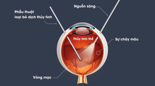 Bị xuất huyết dịch kính mắt là gì? Điều trị ra sao?