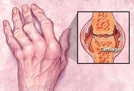 Biến chứng bệnh lupus ban đỏ hệ thống