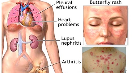 Biến chứng bệnh lupus ban đỏ hệ thống