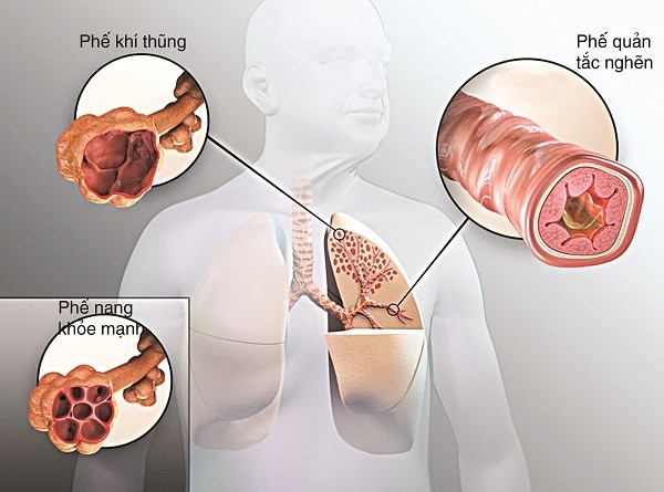 Biến chứng bệnh phổi tắc nghẽn mạn tính