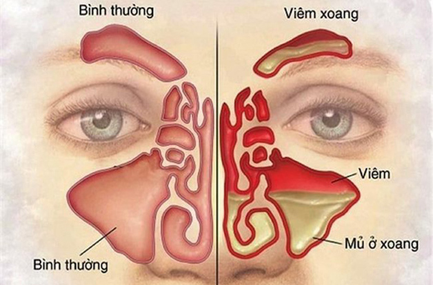 Biến chứng của bệnh viêm xoang mạn là gì?