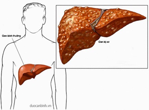 Biến chứng của bệnh xơ gan những tổn thương nghiêm trọng