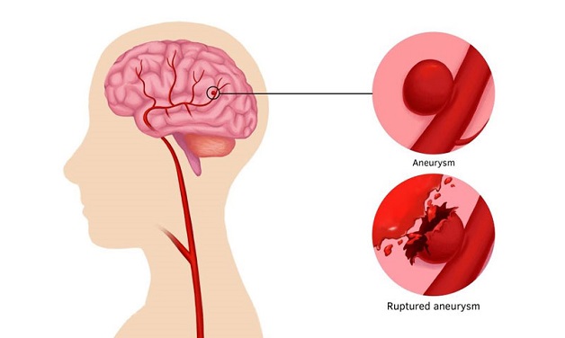 Biến chứng của sốt xuất huyết và cách phòng ngừa