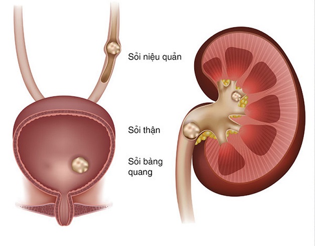 Biến chứng của tán sỏi nội soi ngược dòng sau điều trị là gì?