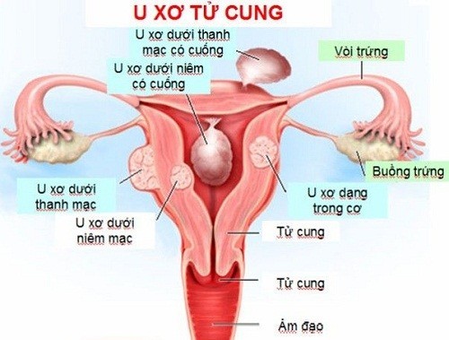 Biến chứng của u xơ tử cung gây ảnh hưởng lớn tới sức khỏe