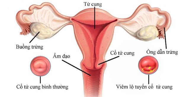 Biến chứng của viêm lộ tuyến cổ tử cung và phương pháp điều trị