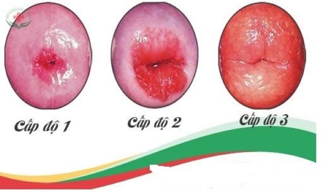 Biến chứng của viêm lộ tuyến cổ tử cung và phương pháp điều trị