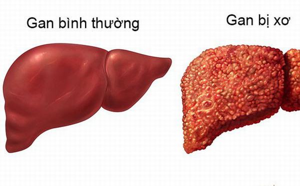 Biến chứng của virut viêm gan C