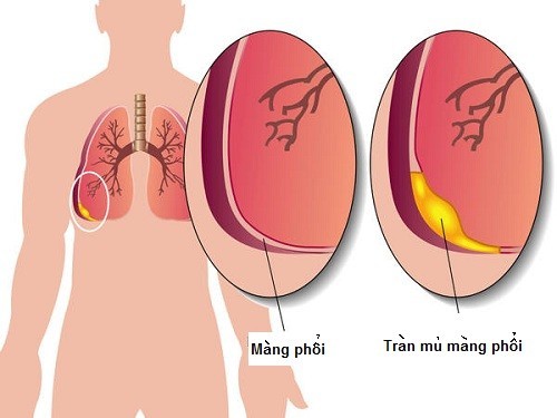 Biến chứng do viêm mủ màng phổi có dấu hiệu bệnh