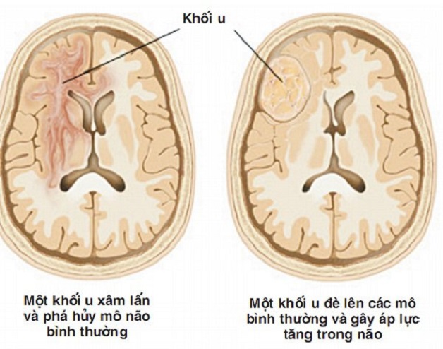 Biến chứng động kinh và các rối loạn tâm thần có liên quan