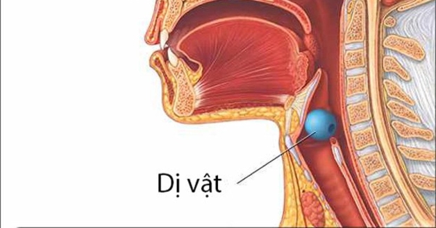 Biến chứng khi bị hóc dị vật ở đường thở