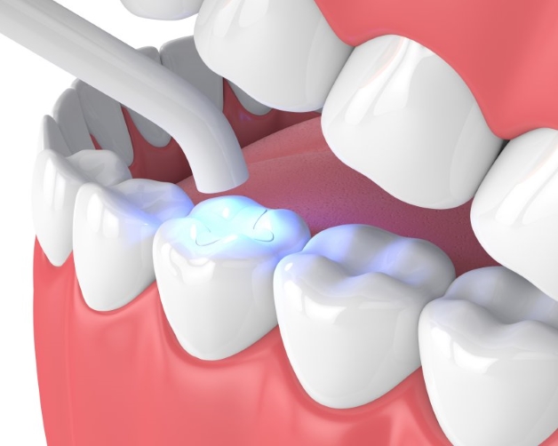 Biến chứng nghiêm trọng từ răng sâu lồi thịt chảy máu