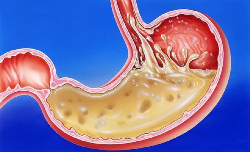 Biến chứng nguy hiểm của trào ngược dạ dày: Những điều cần biết