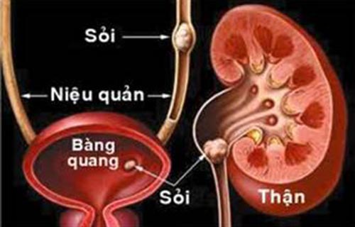 Biến chứng sau mổ sỏi niệu quản