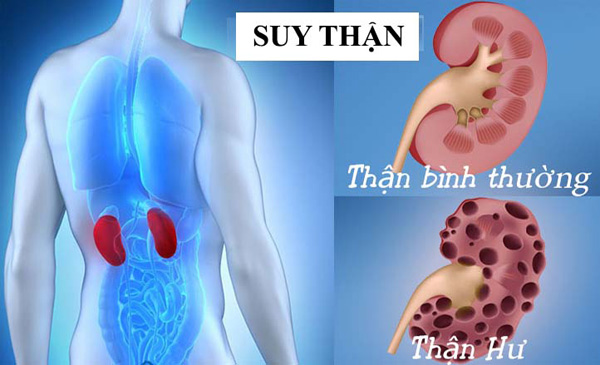 Biến chứng sỏi thận: gây suy giảm chức năng thận